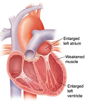 Cardiomyopathy.jpg